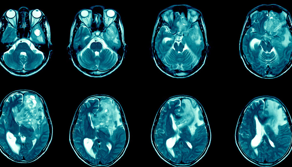 Melatonina: una aliada inesperada contra el tumor cerebral más agresivo