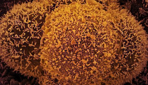 Células CCL-81 (células Vero utilizadas en investigación) fuertemente infectadas con partículas del virus SARS-CoV-2. NIAID / Flickr, CC BY-SA
