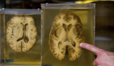 El estudio que publica este lunes Nature Medicine ofrece información sobre por qué algunas personas pueden ser más resistentes que otras al alzhéimer y puede llevar a crear estrategias que "retrasen o prevengan" su aparición. EFE/Stephanie Lecocq/Archivo 	   
