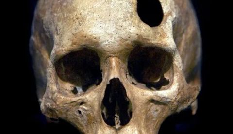 La trepanación más antigua en Oriente Próximo se remonta a la Edad de Bronce