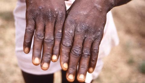 Centers for Disease Control and Prevention, National Center for Emerging and Zoonotic Infectious Diseases (NCEZID)