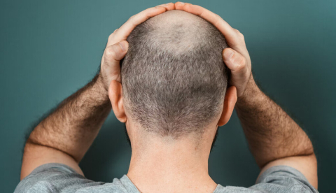 La calvicie cada vez se adelanta más, sobre todo en hombres. STEKLO/Shutterstock