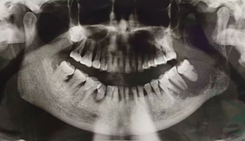 Cómo la pandemia ha influido en el cáncer oral y en su prevención en España