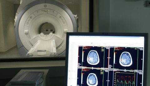 Un equipo de investigadores españoles ha desarrollado nanopartículas capaces de penetrar el tumor cerebral más letal -glioblastoma multiforme- y transportar fármacos al interior de las células malignas. EFE/Archivo