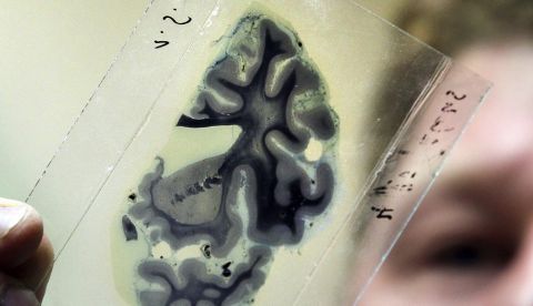 Un grupo internacional de investigadores liderados por la Universidad de Múnich ha descubierto que una proteína relacionada con la inflamación del cerebro ayuda a retrasar la progresión del alzhéimer. EFE/BERND WUESTNECK/Archivo 	   