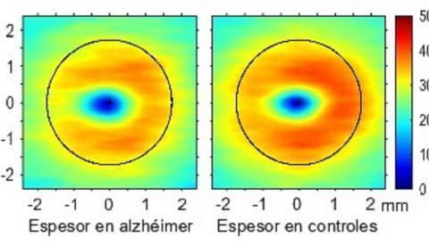 Algunas zonas de la retina experimentan cambios que pueden ayudar a diagnosticar de forma precoz la enfermedad del alzheimer. Imagen cedida por la Universidad Complutense de Madrid. 	   
