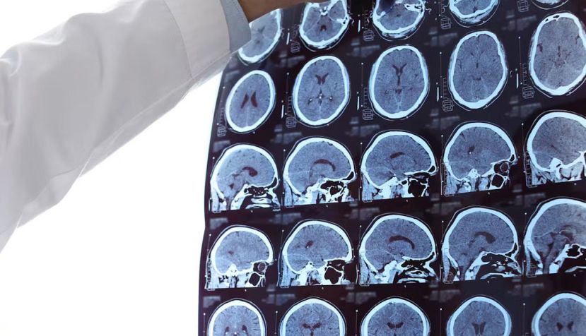Un médico examina resonancias magnéticas de cerebros de pacientes con esclerosis múltiple. New Africa/Shutterstock