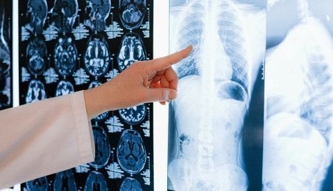 Un estudio confirma la gravedad de la covid en los pacientes con cáncer