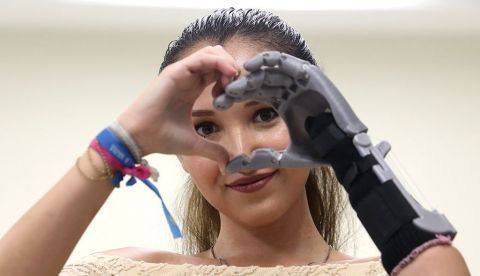 La joven mexicana Marisol Maldonado muestra la prótesis que le fue instalada con tecnología 3D hoy, miércoles 19 de julio de 2017, en el TEC de Monterrey, en Guadalajara (México). EFE