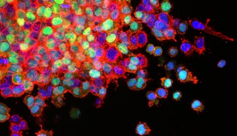 Células de cáncer de pulmón invadiendo los tejidos circundantes (metástasis). National Cancer Institute \ Winship Cancer Institute of Emory University