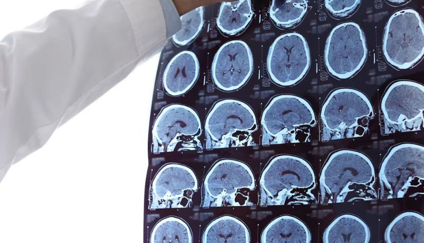 Un médico examina resonancias magnéticas de cerebros de pacientes con esclerosis múltiple. New Africa/Shutterstock
